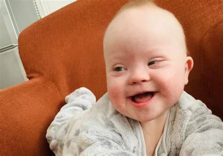 Does Baby Crew Have Down Syndrome?