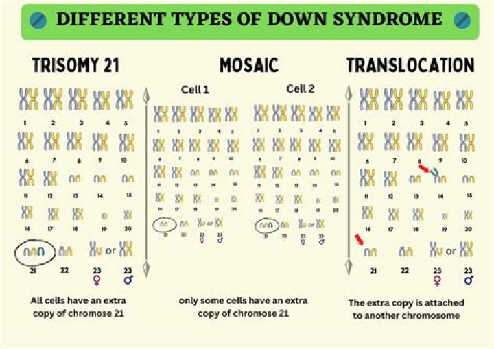Down Syndrome in Babies Types, Causes & Treatment