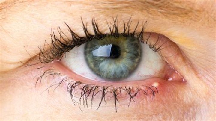 Here's What's Really Causing Your Stye