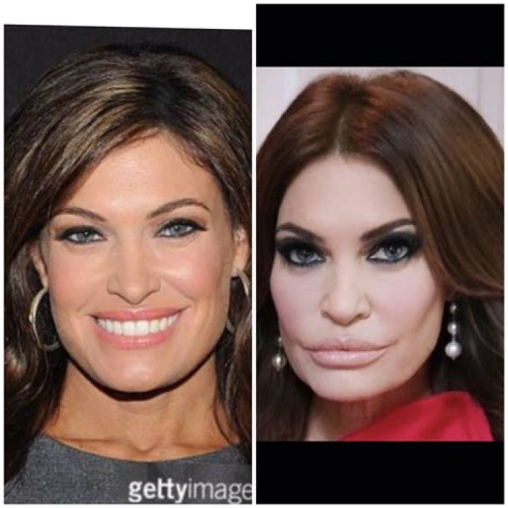 Kimberly Guilfoyle Plastic Surgeries