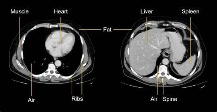 Muscle Pain After CT Scan with Contrast