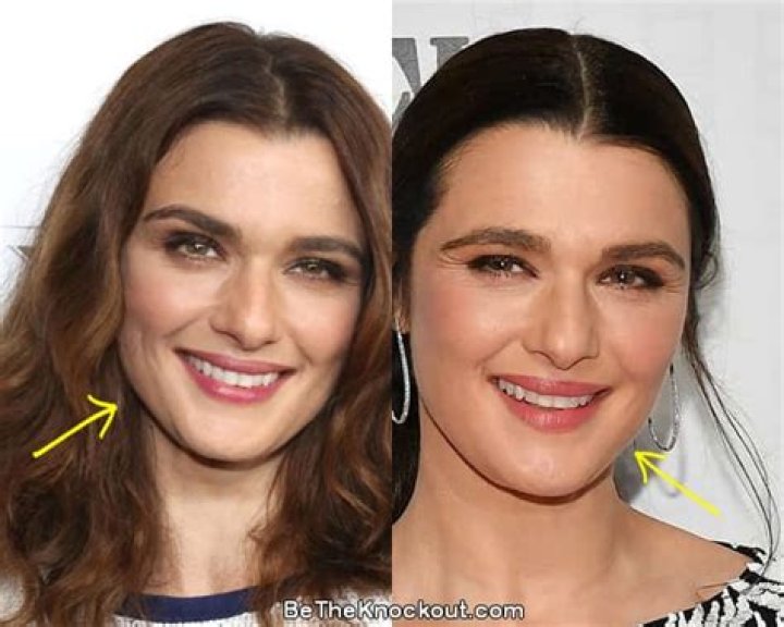 Rachel Weisz Plastic Surgery Before and After Pictures 2024